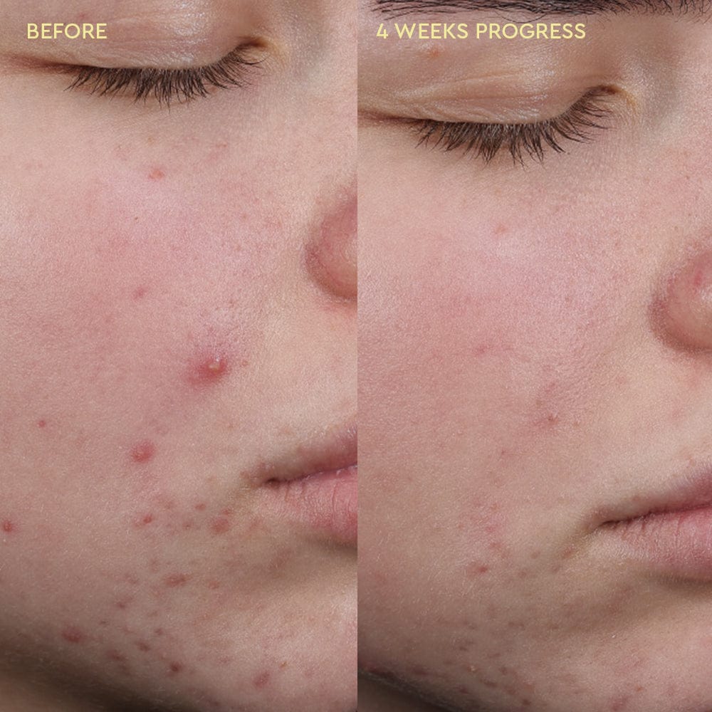 Blemish Clearing Cleanser - Image 5
