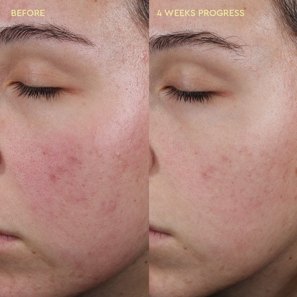 Blemish Control Moisturiser - Image 6